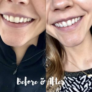 Oral Essentials Whitening Strips