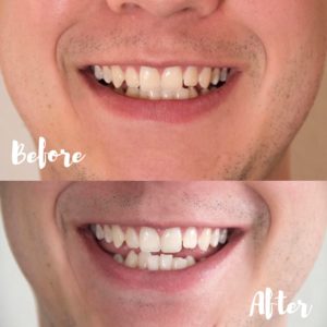 Oral Essentials Whitening Strips